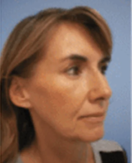 FaceTite Patient before