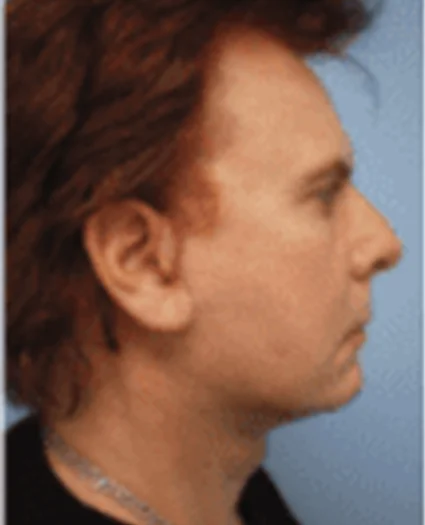 Face Lift Patient After