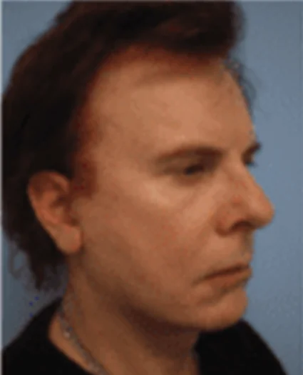 Face Lift Patient After