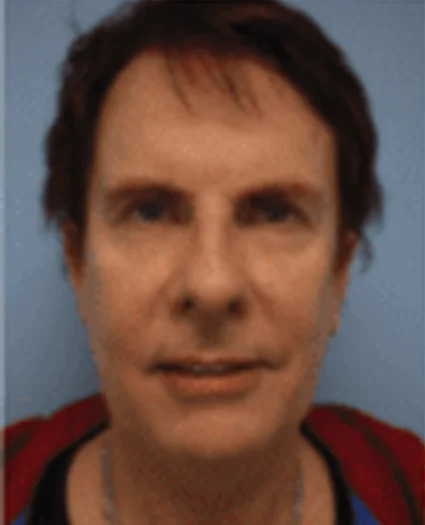 Face Lift Patient Before