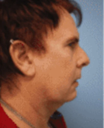 Face Lift Patient Before