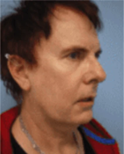 Face Lift Patient Before