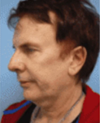 Face Lift Patient Before