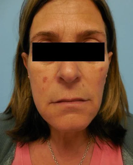 Face Lift Patient After