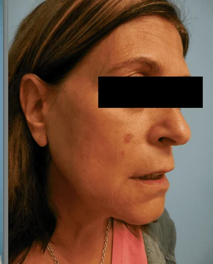 Face Lift Patient After