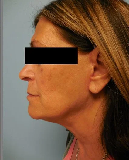 Face Lift Patient After