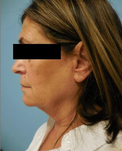 Face Lift Patient Before