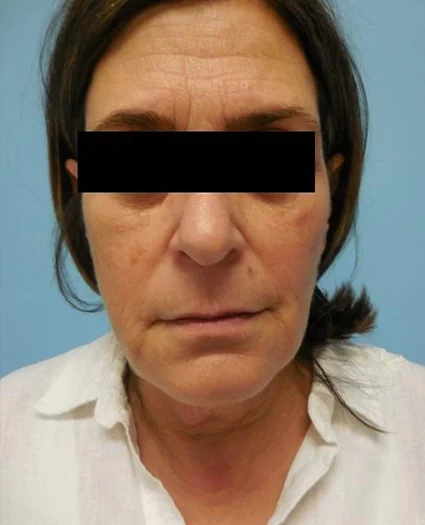 Face Lift Patient Before