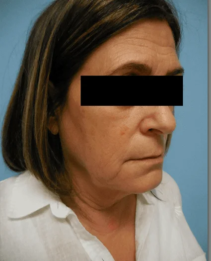 Face Lift Patient Before
