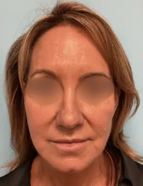 Face-Lift-Patient-4-after-1