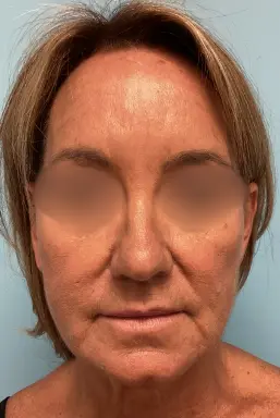 Face-Lift-Patient-4-before-1