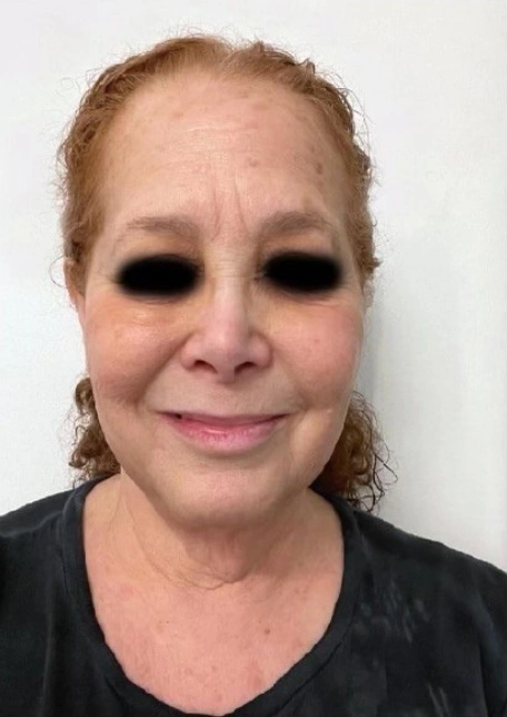 Face Lift Patient 5 Before