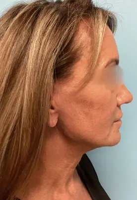 Face-Lift-Patient-4-after-2