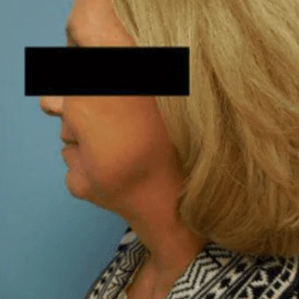 FaceTite Patient after