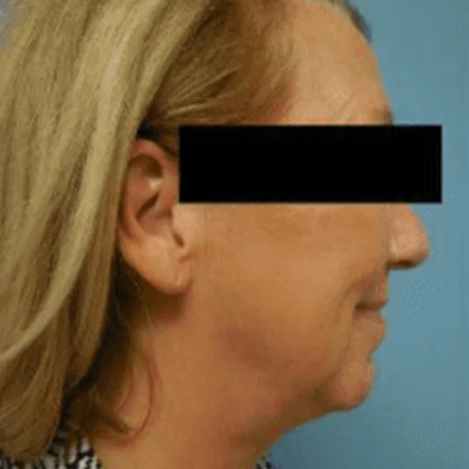 FaceTite Patient after