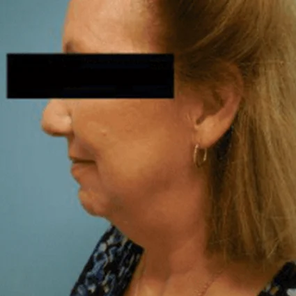 FaceTite Patient before