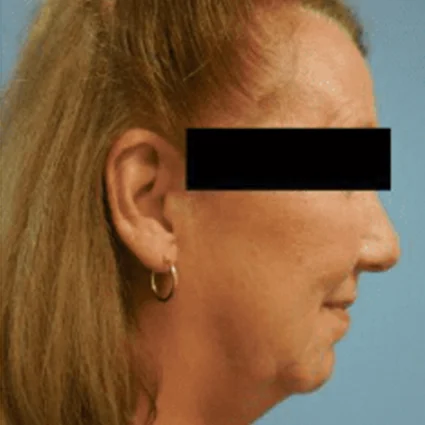 Nose Reshaping Patient Before