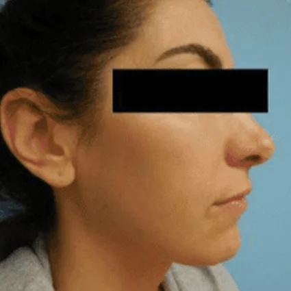 FaceTite Patient after