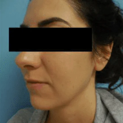 FaceTite Patient after