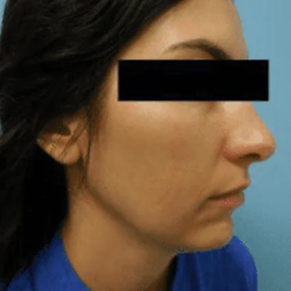 FaceTite Patient before