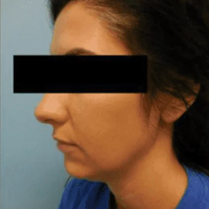 FaceTite Patient before