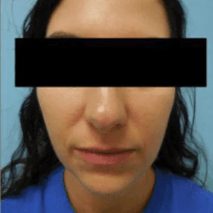 FaceTite Patient before