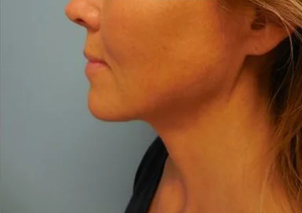 FaceTite Patient after