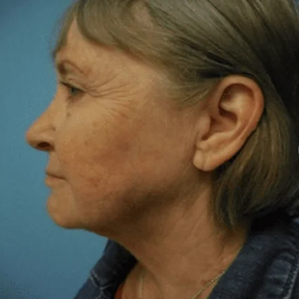 FaceTite Patient after