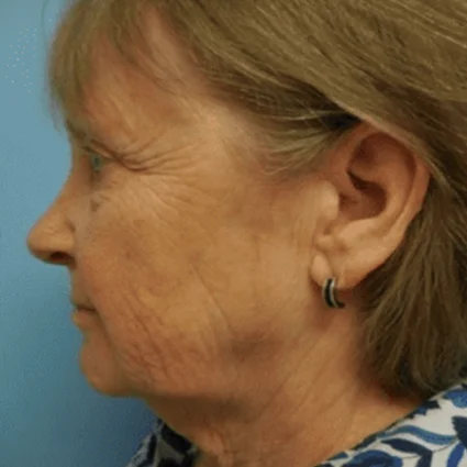 FaceTite Patient before