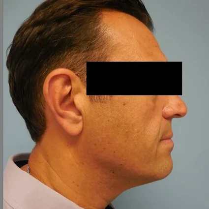 FaceTite Patient after