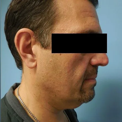 FaceTite Patient before