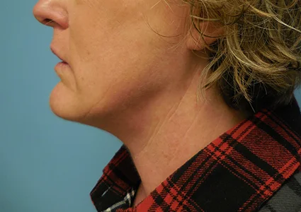 FaceTite Patient after