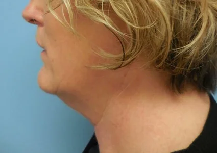 FaceTite Patient before