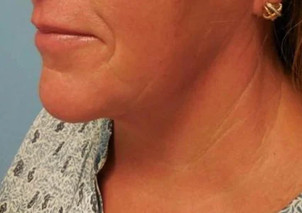 FaceTite Patient after