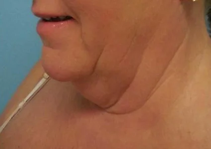 FaceTite Patient before