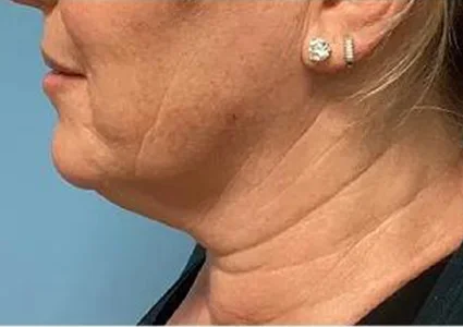 FaceTite Patient before