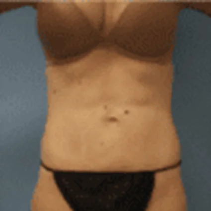 Liposuction Patient after