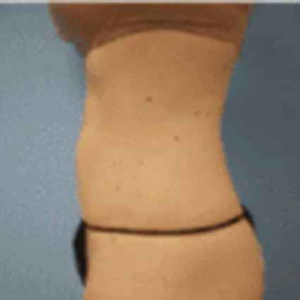 Liposuction Patient after