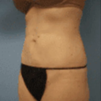 Liposuction Patient after