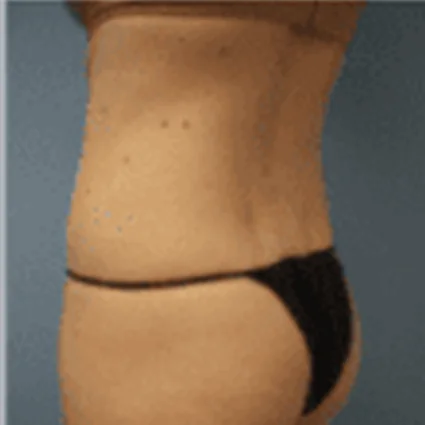 Liposuction Patient after