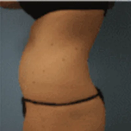 Liposuction Patient before