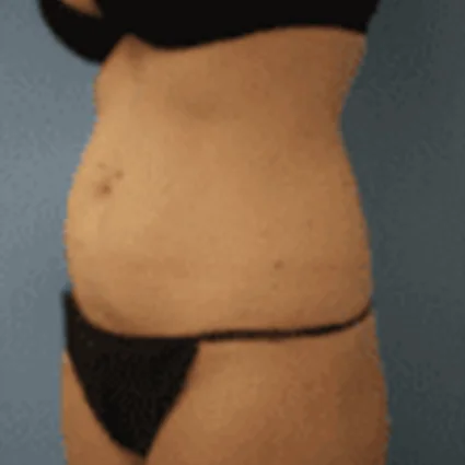 Liposuction Patient before