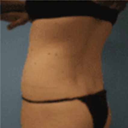 Liposuction Patient before