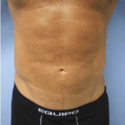Liposuction Patient after