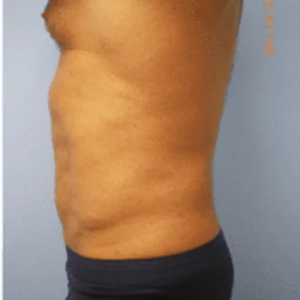 Liposuction Patient after