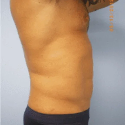 Liposuction Patient after