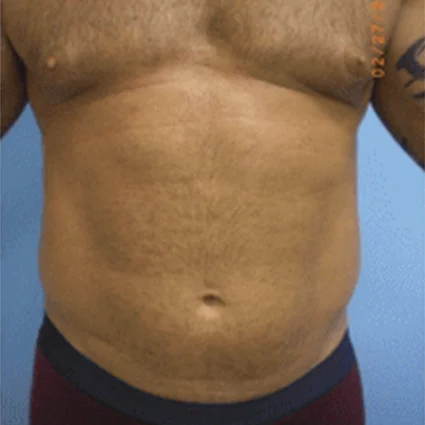 Liposuction Patient before