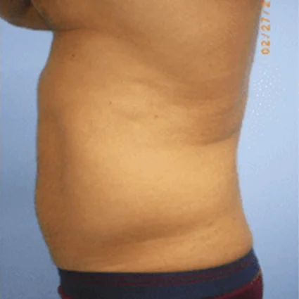 Liposuction Patient before