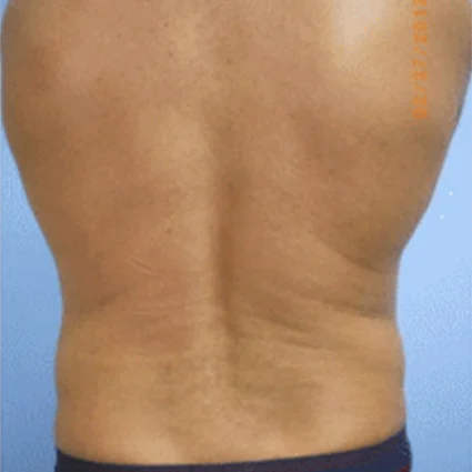 Liposuction Patient before