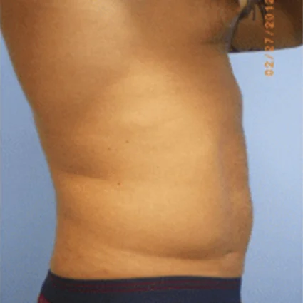 Liposuction Patient before